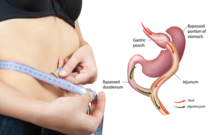 Laparoscopic Gastric Bypass Surgery